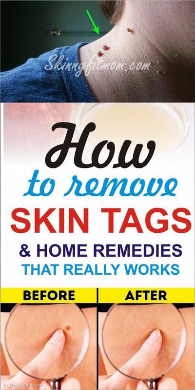 Skin Tag Removal Methods - 5 Ways to Get Rid of Skin Tags