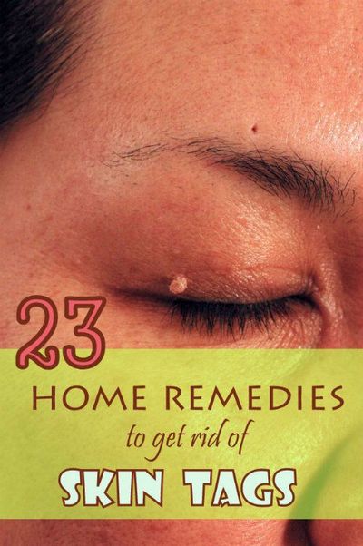 Skin Tag Removal Methods - 5 Ways to Get Rid of Skin Tags