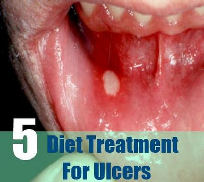 What Are the Different Types of Mouth Ulcers?