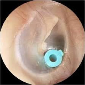 Ear Tubes