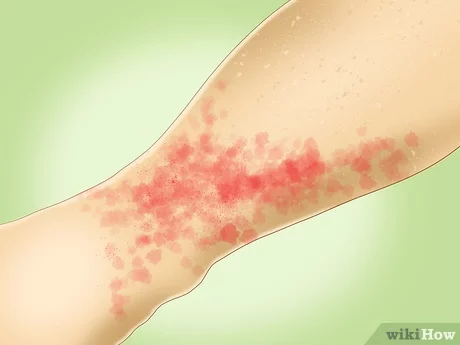 Petechiae Home Treatment - Effective Remedies For Red Petechiae